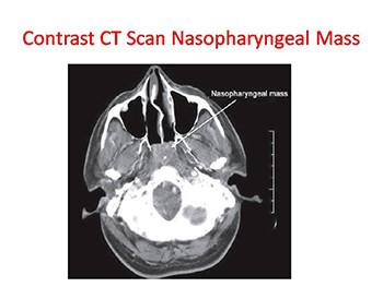 TUMORS OF NASOPHARYNX