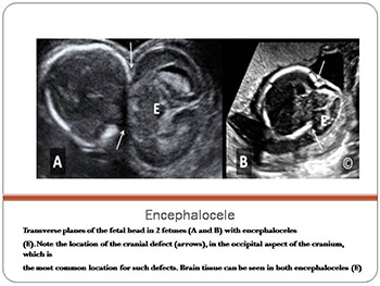 Diagnosis of Fetal Malformation By Ultrasound