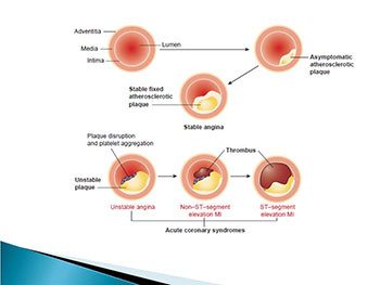 Myocardial Infarction