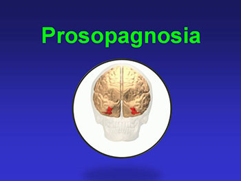 Prosopagnosia