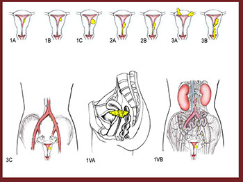Cervix Uteri Cancer