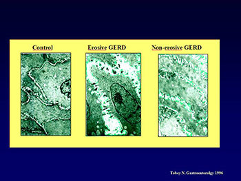 GERD and Complications