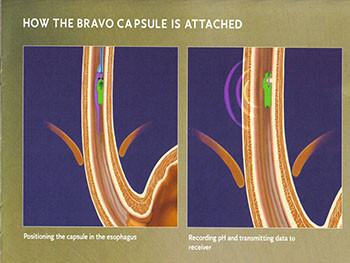 Gastroesophageal Reflux Disease