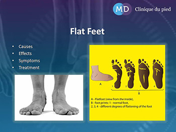Flat Feet-Causes Effects Symptoms and Treatment