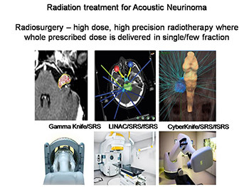 Acoustic Neurinoma Cyberknife Radiosurgery