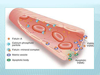 Chronic Kidney Disease