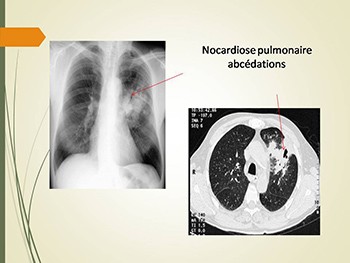 Pneumopathie Infectieuses et Immunodepressions