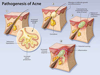 Acne Disease