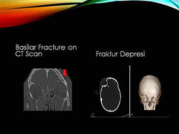 Head Injury in Children