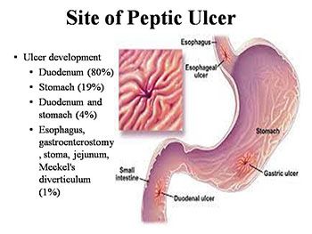 Peptic Ulcer Disease