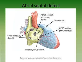 Congenital Heart Diseases in Adults