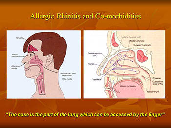 Allergic Rhinitis and co-morbidities in children