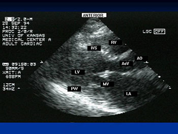 Mitra Valvular Disease