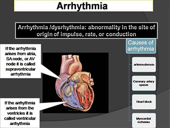 Antiarrhythmic Drugs