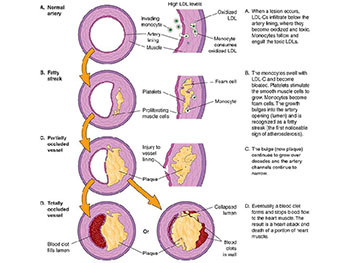 Coronary Hear Disease