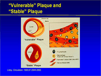 Myocardial Infarction