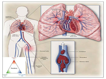 Acute Pulmonary Embolism-Diagnosis and Management