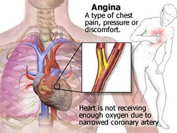 Angina Pectoris