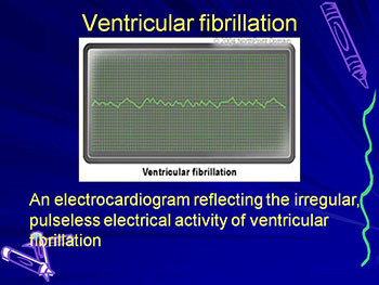 Arrhythmia