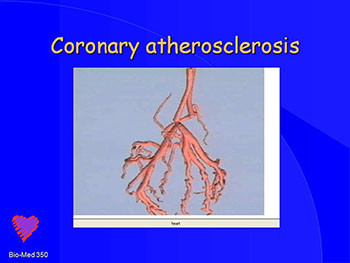 Complications of Acute M I