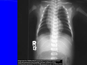 Approach to Cyanotic Congenital Hear Disease