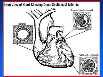 Arteriosclerosis and Coronary Heart Disease-CHD