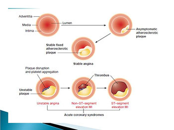 Mycardial Infarction