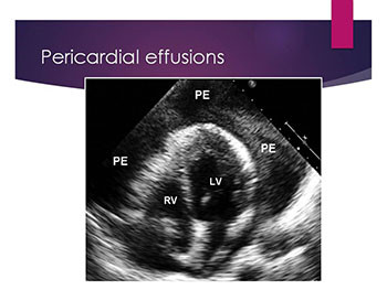 Select disorders of the Pericardium and Myocardium 