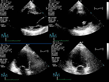 Pregnancy and the Heart and Vessels