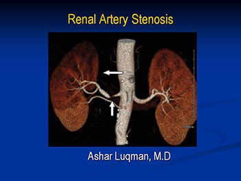 Renal Artery Stenosis 