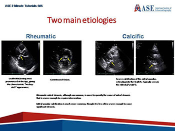 Acquired Mitral Stenosis in the Adult