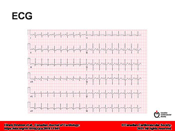 Pulmonary Hypertension-Whats New