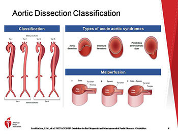 Guideline for the Diagnosis and Management of Aortic Disease 