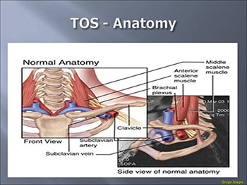 Thoracic Outlet Syndrome 