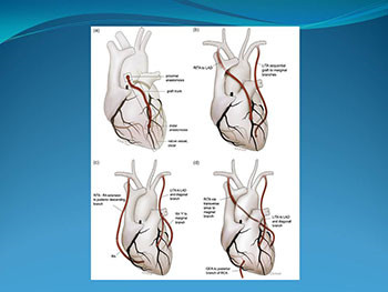 Arterial conduits in coronary artery bypass grafting: an inconvenient truth
