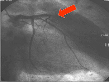 Management of Coronary Artery Disease 