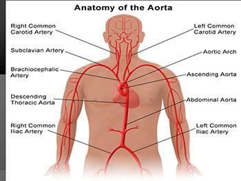 Nursing Care Plan of Aortic Aneurysm 