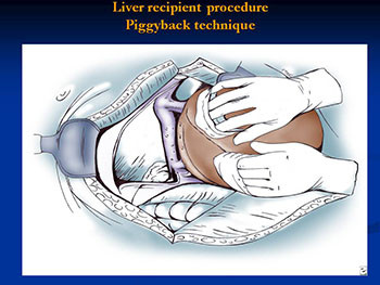 Liver & GI Transplanation 