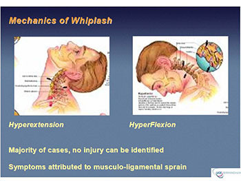 Botulinum toxin use in post traumatic cervical dystonia and head tremor