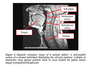 Obstructive Sleep Apnea Syndrome