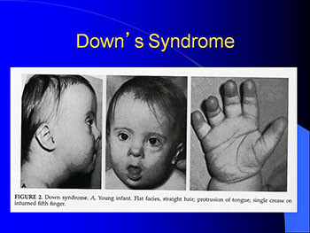 Intellectual Disability