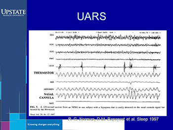 Obstructive Sleep Apnea and Upper Airway Resistance Syndrome