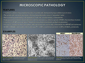 Malignant Peripheral Nerves Heath Tumors-MPNST