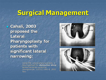 Surgical Management of Obstructive Sleep Apnea