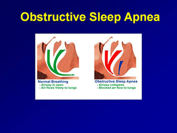Obstructive Sleep Apnea and Obesity Hypoventilation Syndrome