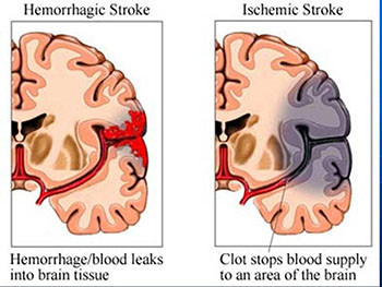 Stroke In The Young Adult