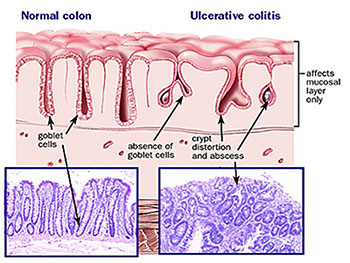 Inflammatory Bowel Diseases