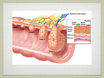 Colorectal Cancer