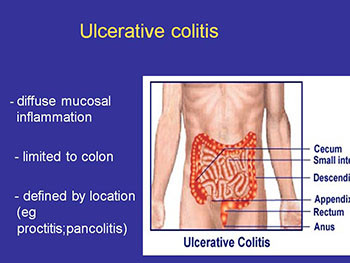 Drug Treatment of Inflammatory Bowel Disease