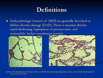 Acute Respiratory Distress Syndrome